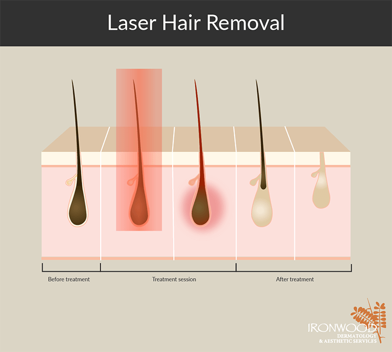  Learn the steps of laser hair removal at Tucson and Oro Valley’s Ironwood Dermatology.