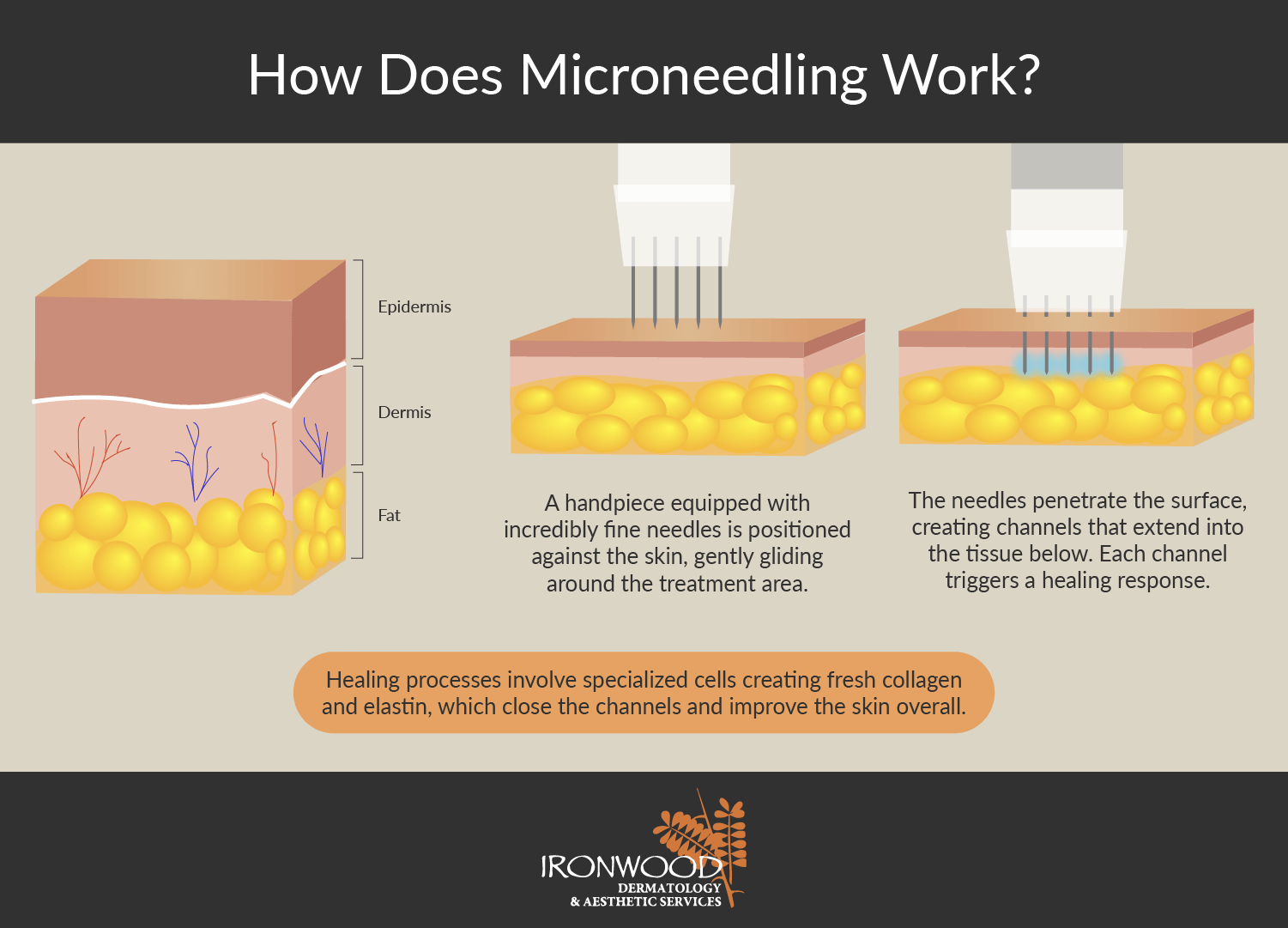  See how microneedling works at Oro Valley and Tucson’s Ironwood Dermatology.