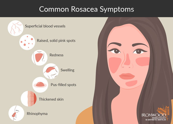 Learn the most common symptoms of rosacea from Tucson and Oro Valley's Ironwood Dermatology.