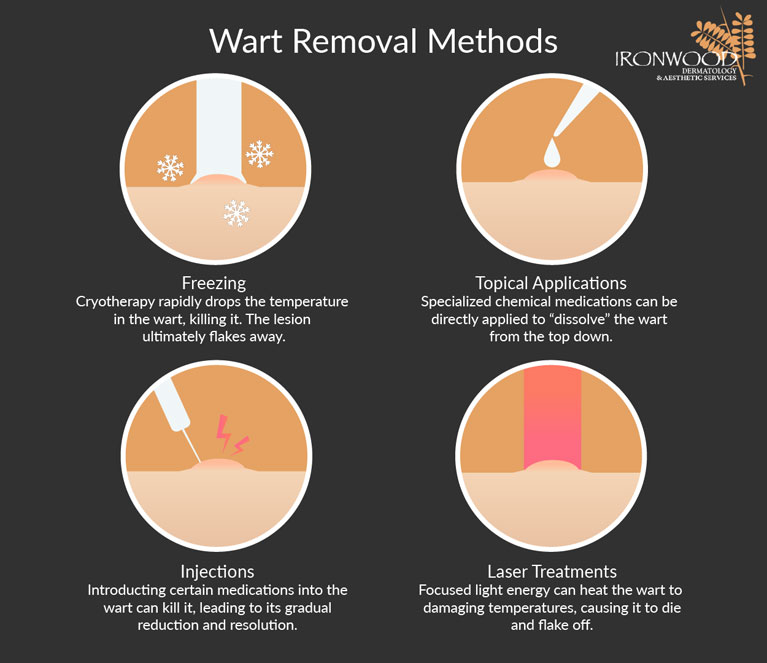 Learn more about treatments for warts at Oro Valley and Tucson's Ironwood Dermatology.